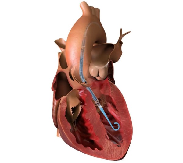 ▲존슨앤존슨 메드테크의 초소형 인공심장펌프 임펠라CP