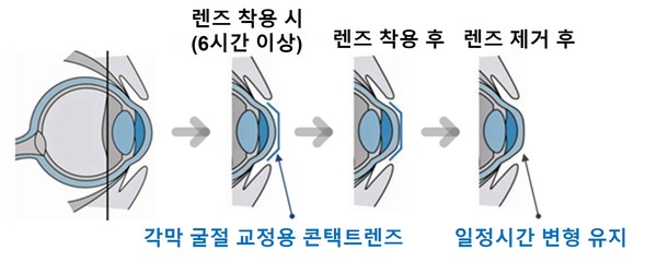 ▲각막 굴절 교정용 콘택트렌즈의 작용원리