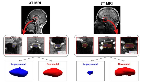▲3T MRI-7T MRI 뇌하수체 분할 성능 비교 연구자료<br>